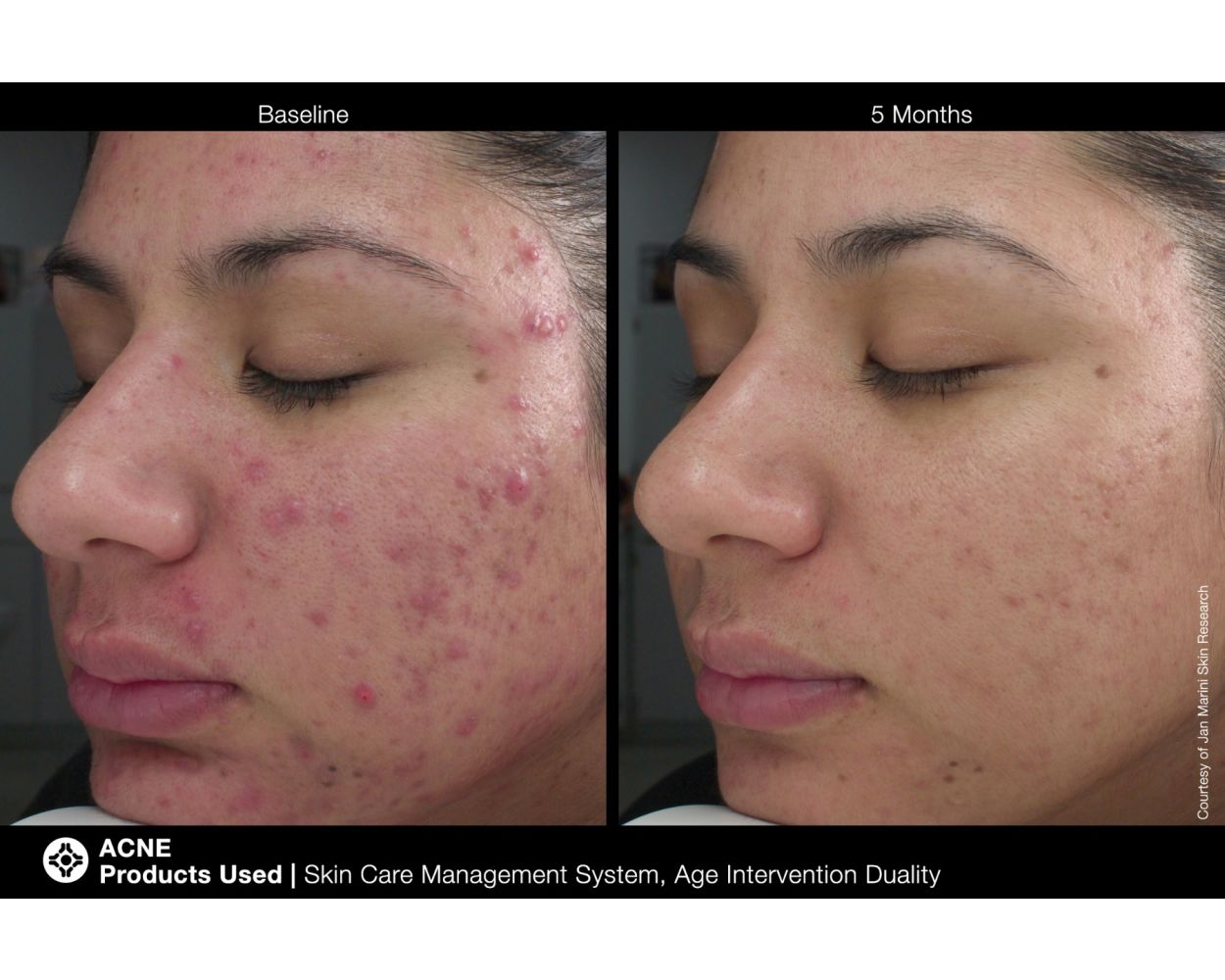 Marini Age Intervention® Duality™
