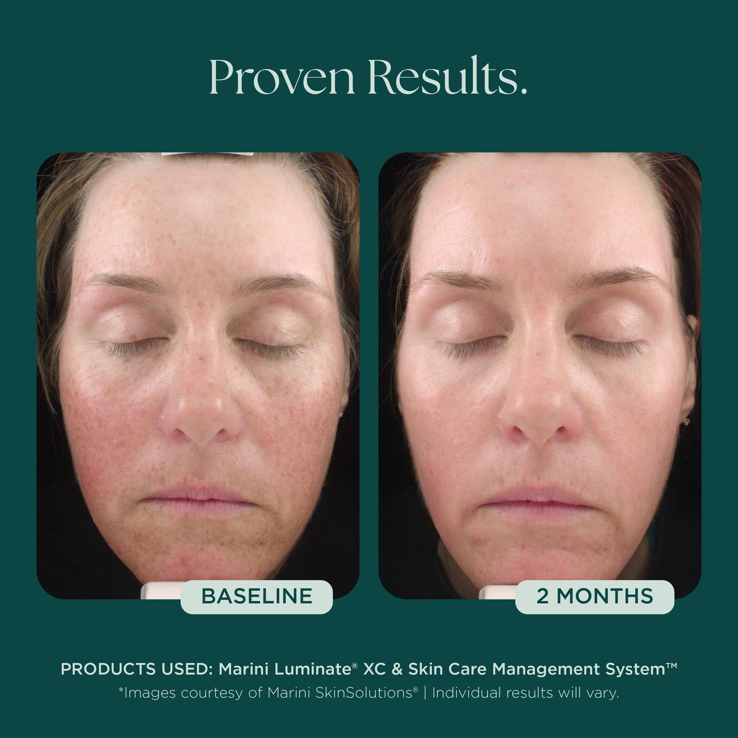 Marini Luminate® XC